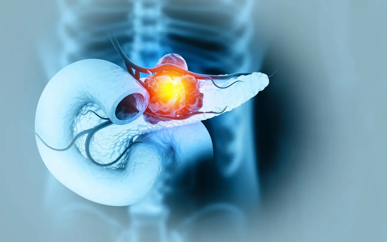 AI model detects hidden pancreatic cancer up to 3 years before doctors spot it on CT scans