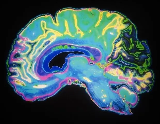 AI-powered deep brain stimulation adapts in real time to improve gait in Parkinson's disease